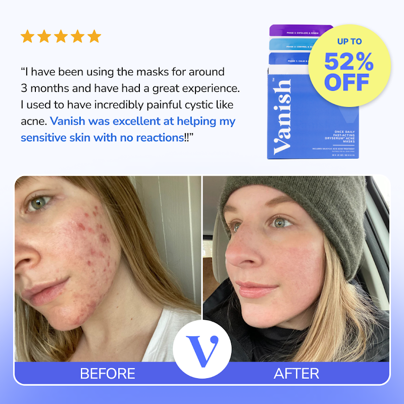 Vanish DrySerum before-and-after results