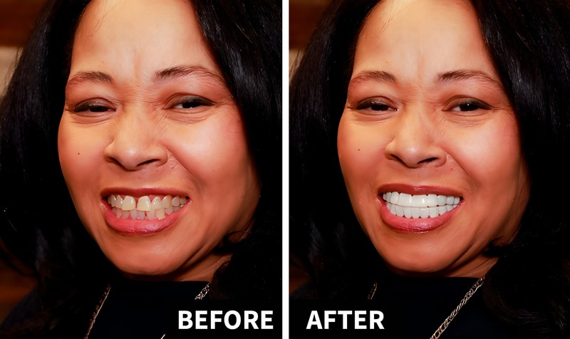 Shiny Smile Veneers close-up detail
