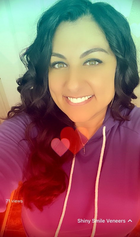 Shiny Smile Veneers — view 4