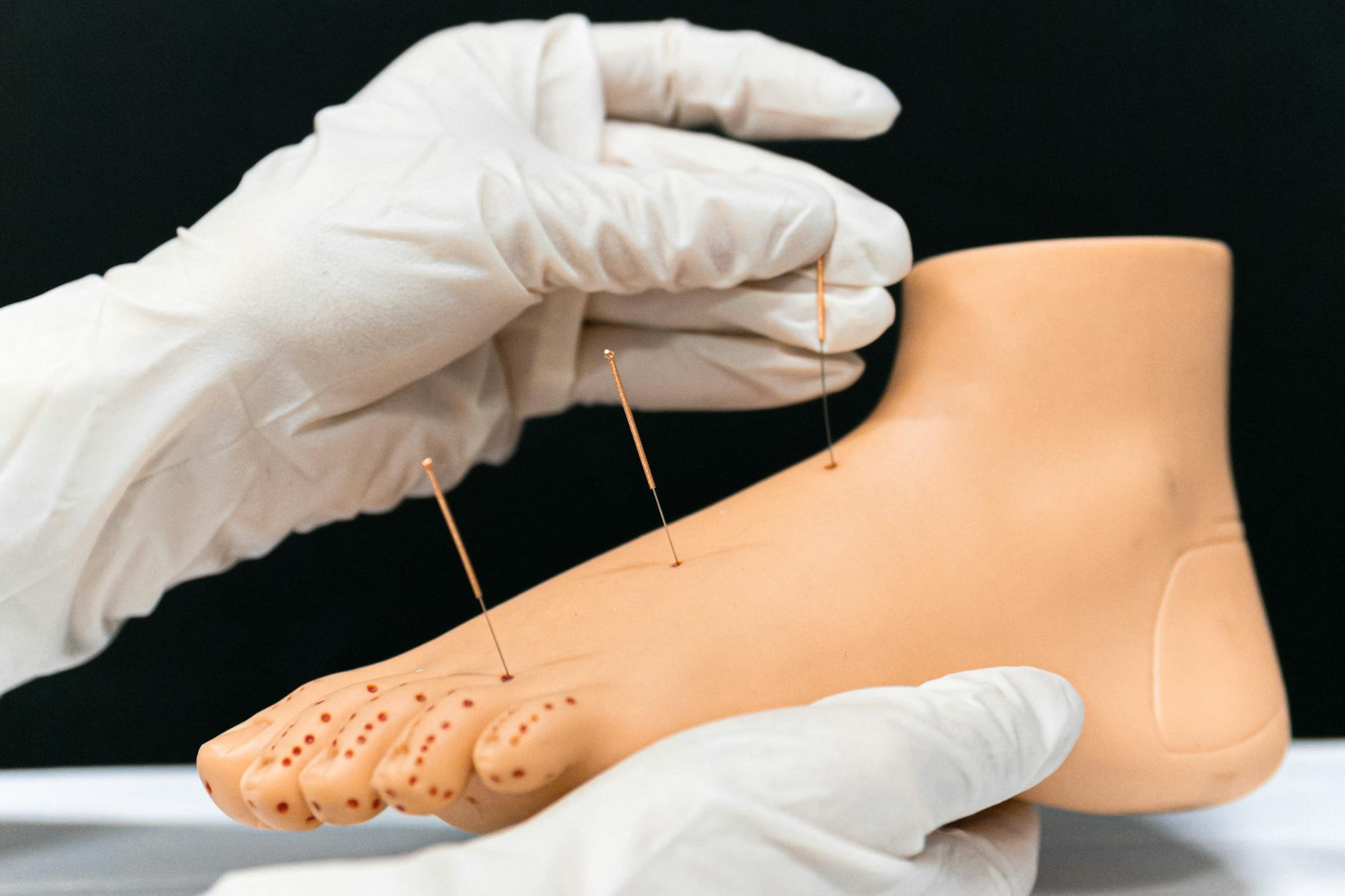 Acupuncture needles inserted for pain relief as a knee replacement alternative