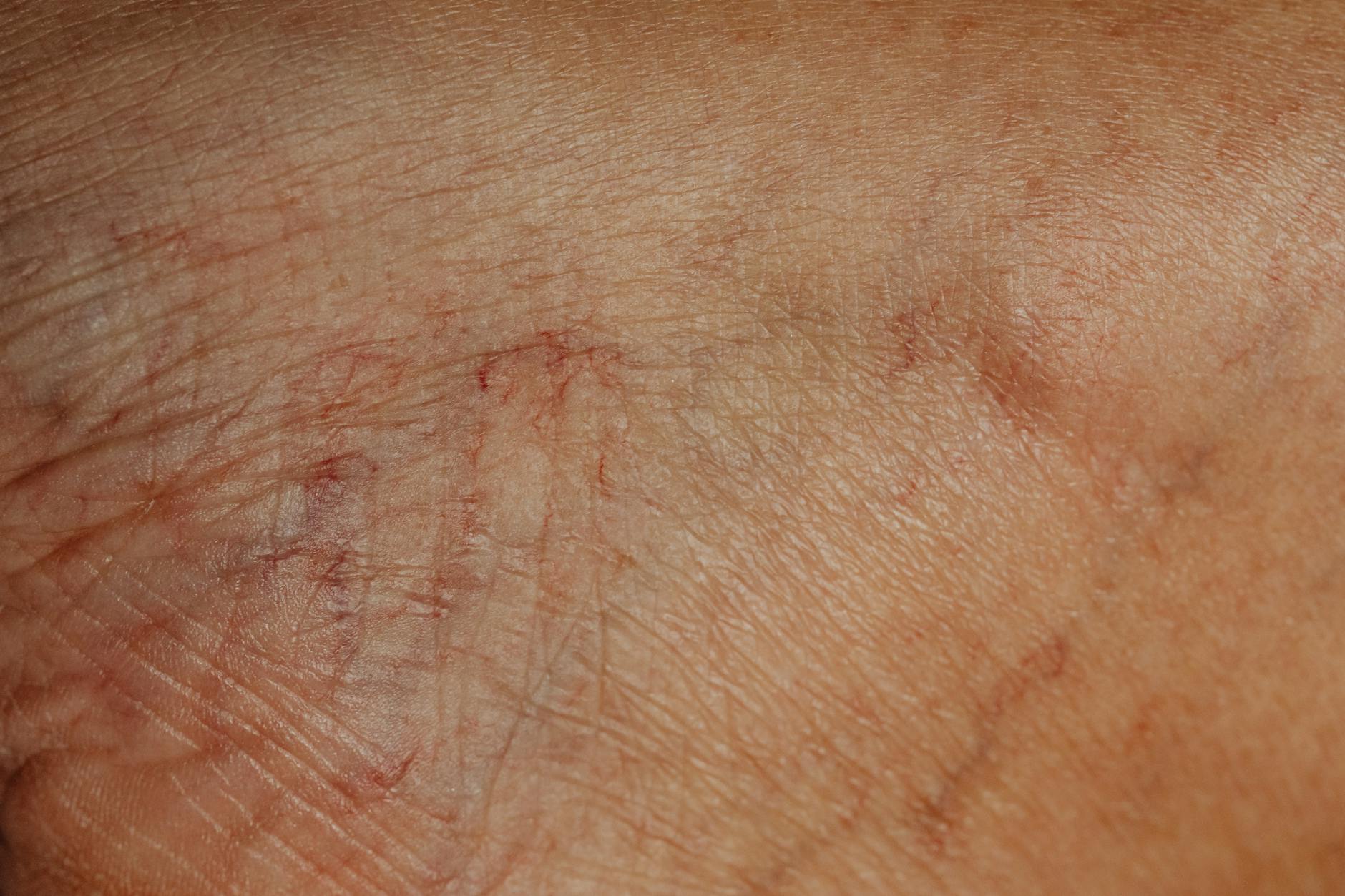 Close-up of aging skin texture showing fine wrinkles and loss of elasticity associated with crepey skin on arms