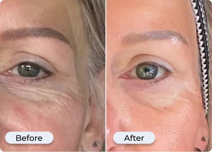 Glamory MicroLift System before and after results — skin firming and fine line reduction