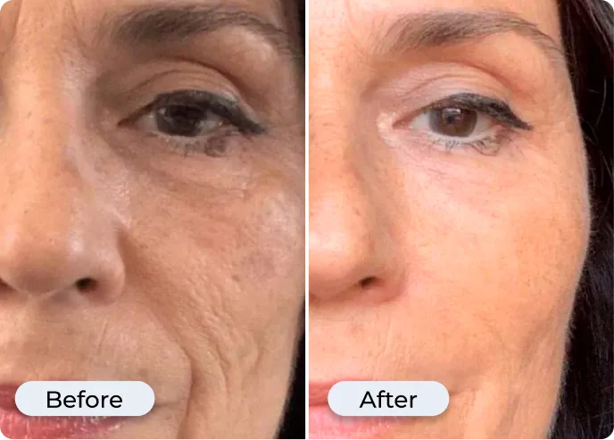 Glamory MicroLift System being used on face — micro infusion device at home demonstration