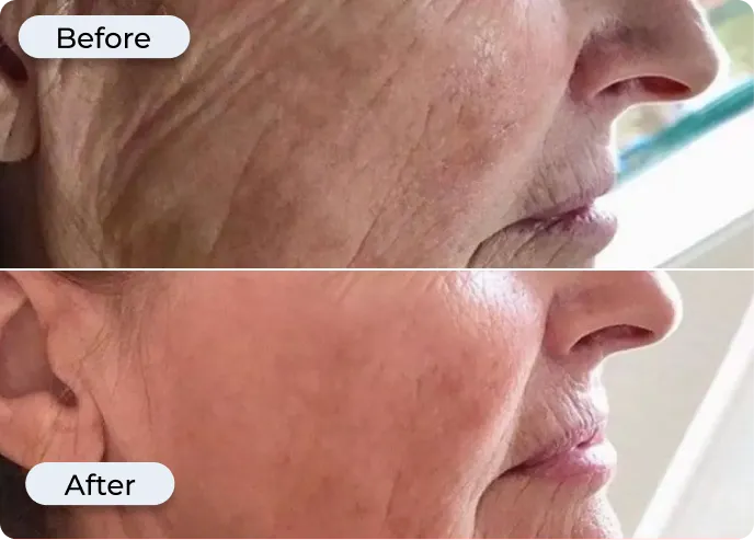 Glamory MicroLift System results — improved skin radiance, firmness, and fine line reduction after 30 days