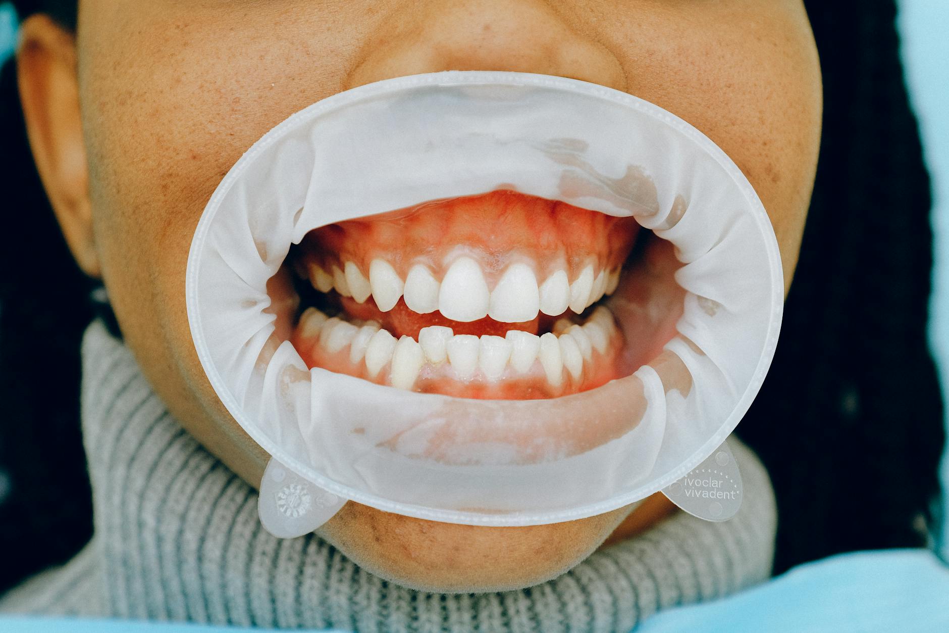 Dental Examination for Gum Health Close-up dental checkup showing gum and tooth examination with cheek retractor