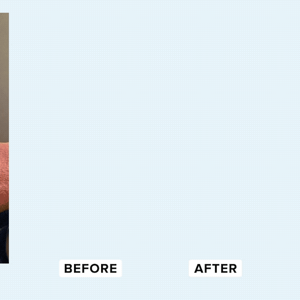 Dental professional reviewing teeth alignment model — Laughland dentist-formulated whitening kit