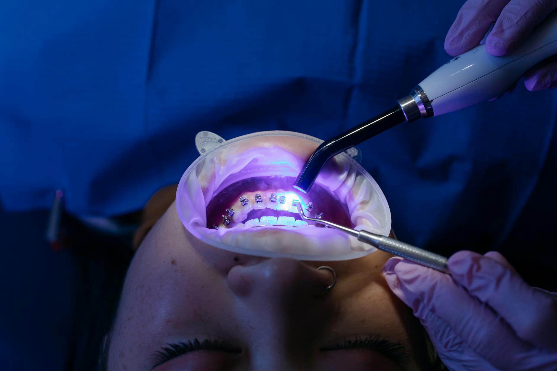 Dental professional using UV light curing device during teeth whitening treatment