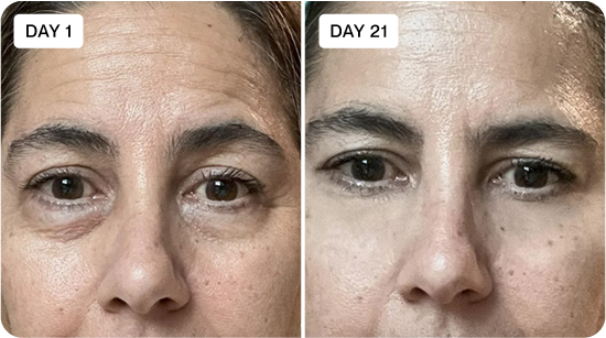 Renewa EyeLift Review 2026: We Tested It for 30 Days — Here's What Happened
