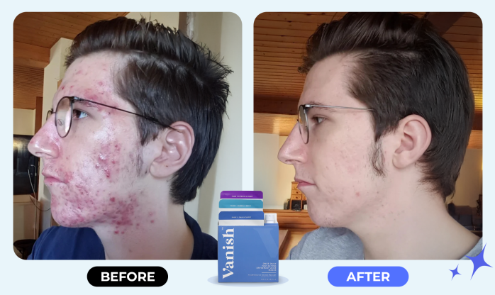 Vanish DrySerum before and after results showing acne improvement after consistent use